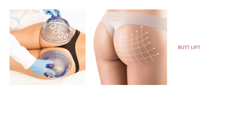 Aestiva Butt lift Clinic Delhi, Mumbai, Jaipur, Bangalore, Pune.